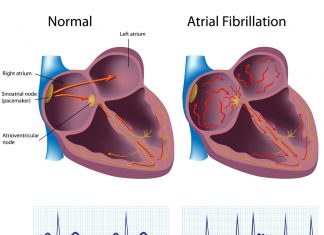 Hjartsláttartruflanir