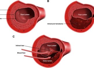 Fróðleiksmoli – SCAD: rof í æðavegg kransæðar SCAD rof í kransæð.